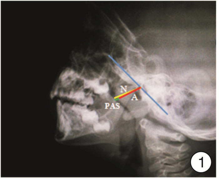 adenoid hypertrophy x ray