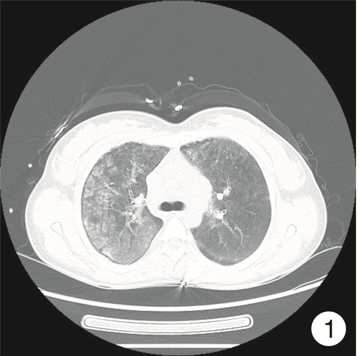 Adult idiopathic pulmonary hemosiderosis with pulmonary 