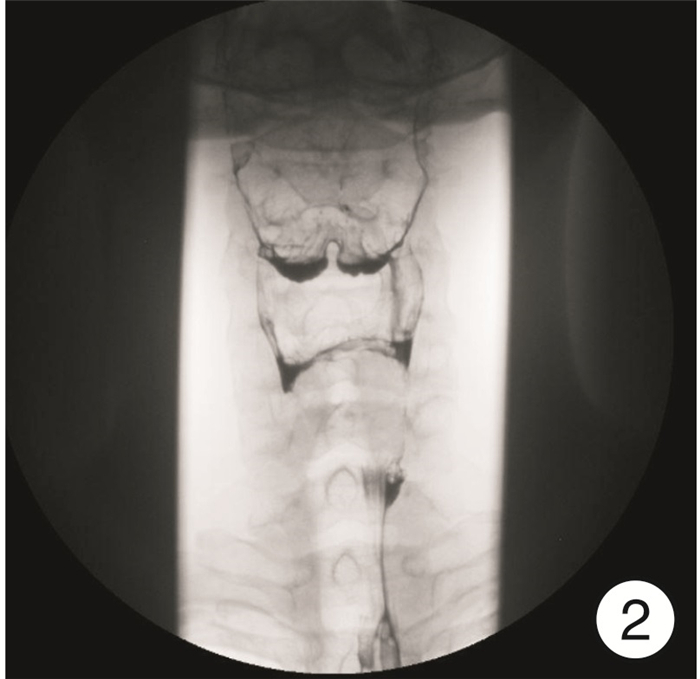 The Clinical Value Of Recurrent Laryngeal Nerve Dissection In The Surgical Treatment For