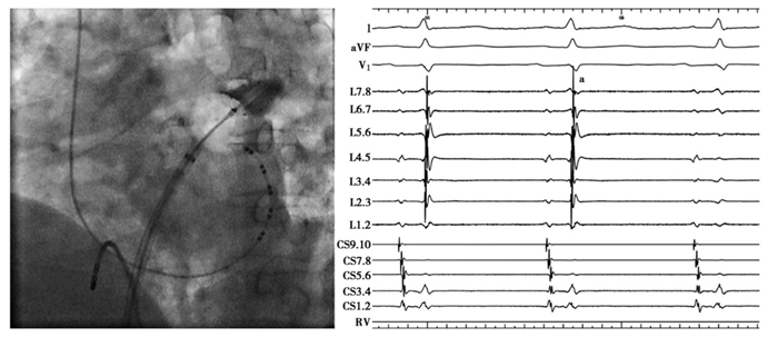 Efficacy and safety of second-generation cryoballoon ablation on the ...